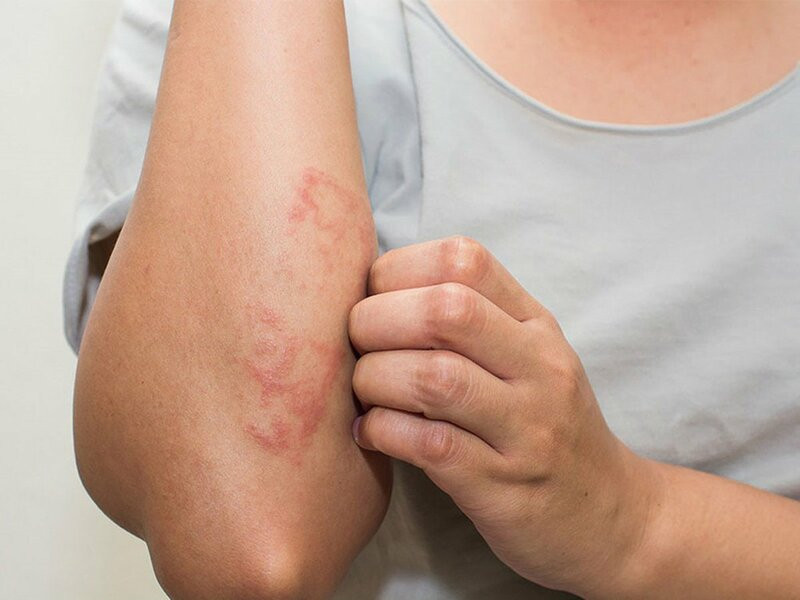 Viêm mao mạch dị ứng: Không quá đáng sợ nhưng cần nhận biết đúng bệnh