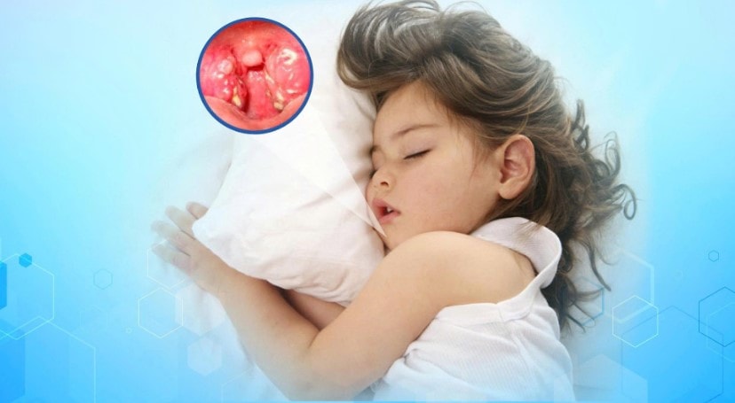 Ngưng thở khi ngủ do amidan quá phát ở trẻ nhỏ, phụ huynh không nên chủ quan