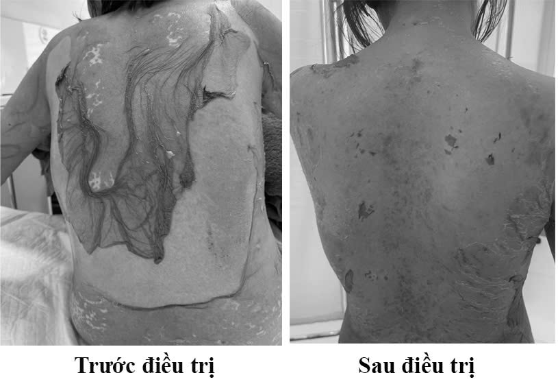 Tự uống thuốc dị ứng, người phụ nữ bị “lột da” toàn thân vì hội chứng hiếm gặp