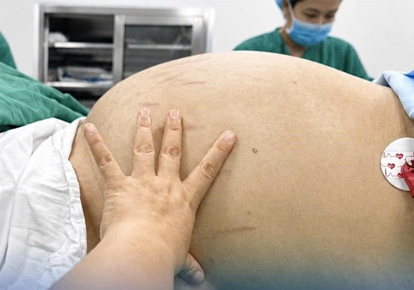 Cô gái 19 tuổi mang khối u buồng trứng gần 30cm chỉ vì tưởng tăng cân