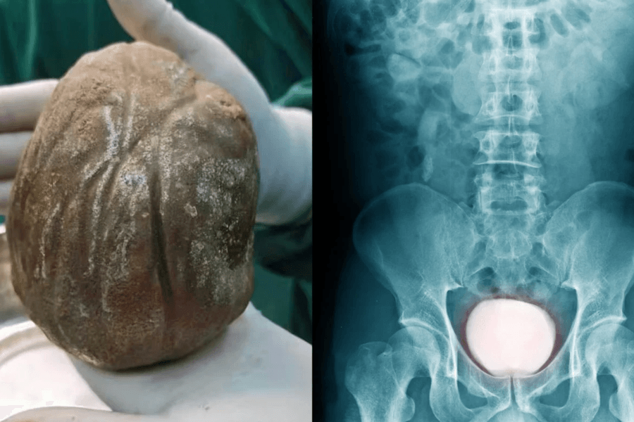 Đau đớn mang “khối đá” 1,3kg trong cơ thể suốt nhiều năm vì ngại đi khám
