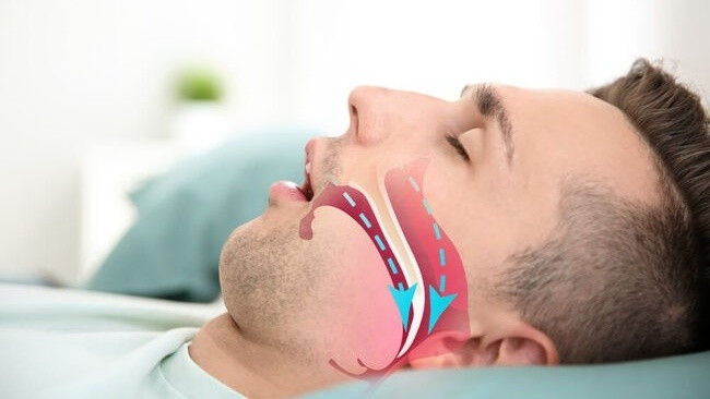Ngáy to kéo dài, chuyên gia cảnh báo nguy cơ ngưng thở khi ngủ