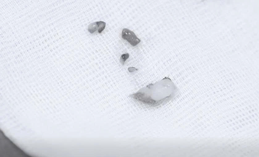 Hy hữu: Phát hiện răng mọc trong hốc mũi của bé 8 tuổi