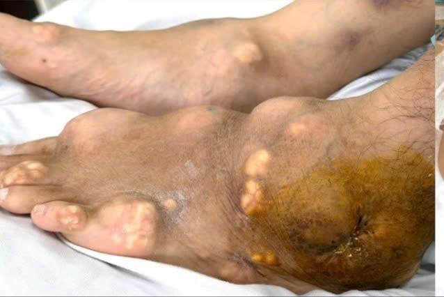 Suýt mất mạng vì nhiễm khuẩn huyết nặng từ lối sống thiếu lành mạnh