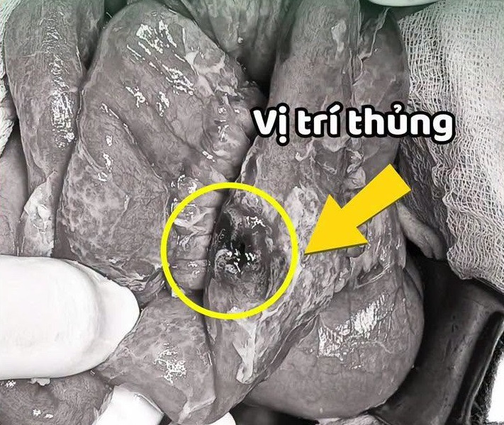 Chủ quan trước cơn đau bụng, người đàn ông bất ngờ phát hiện ung thư hiếm gặp
