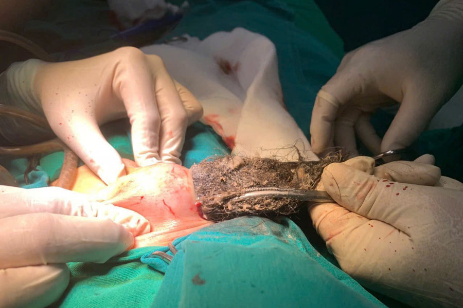 Đau bụng, nôn nhiều, bé trai 46 tháng tuổi phát hiện búi tóc khổng lồ trong dạ dày