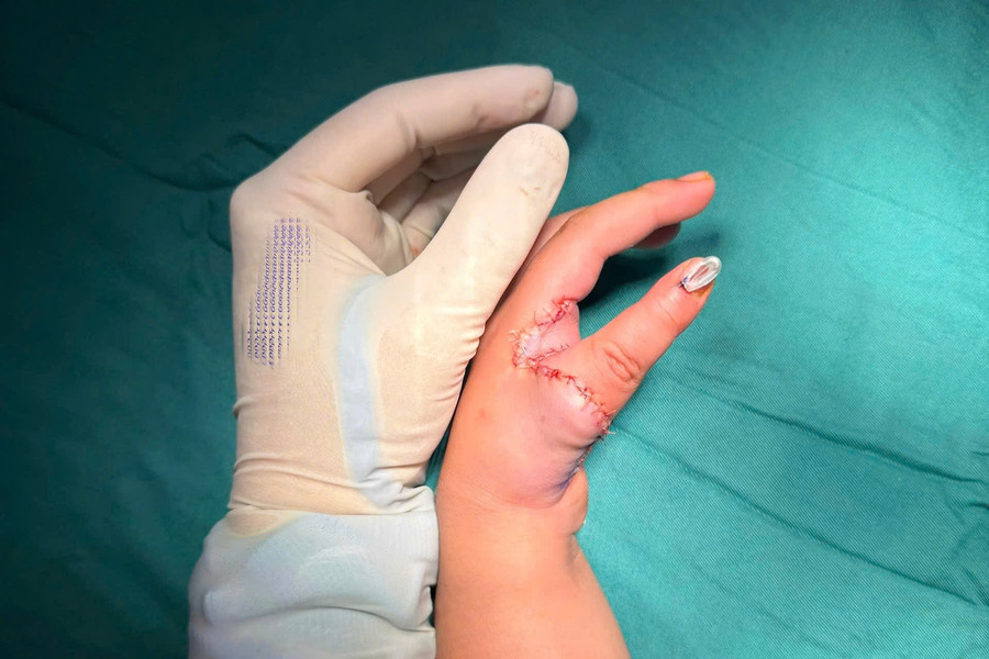 Tái tạo ngón cái từ ngón trỏ, mở ra cơ hội mới cho trẻ mắc dị tật bẩm sinh