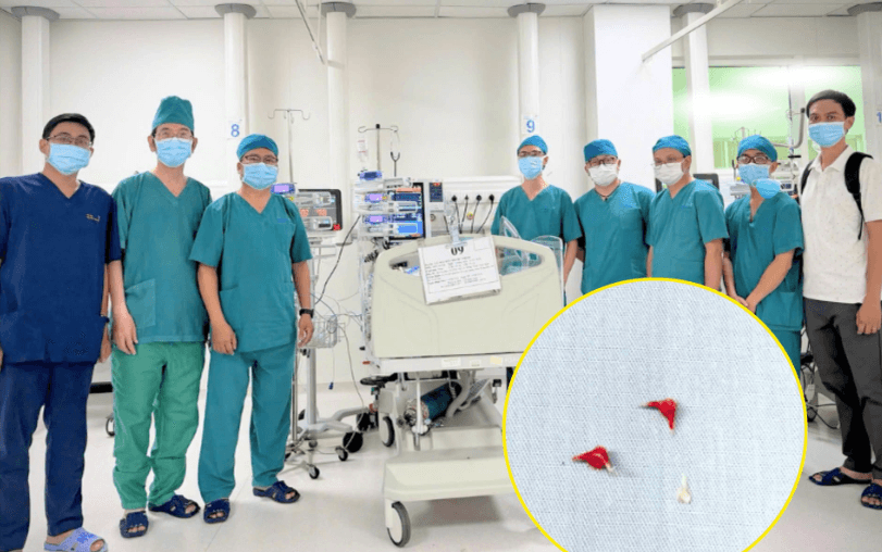 Hai bệnh viện phối hợp lấy thành công 3 mảnh xương lươn cho bé 7 tháng tuổi